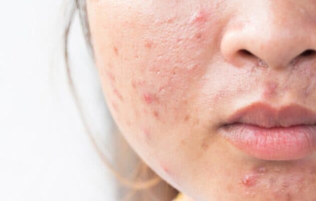 acne hormonal imbalance