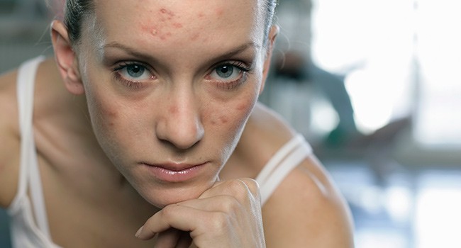 adult acne treatment